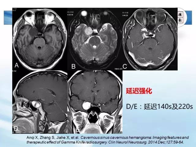 【病例】鞍区海绵状血管瘤1例MR影像表现与鉴别