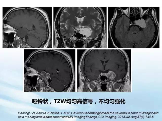 【病例】鞍区海绵状血管瘤1例MR影像表现与鉴别