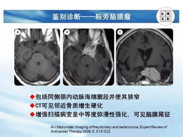 【病例】鞍区海绵状血管瘤1例MR影像表现与鉴别