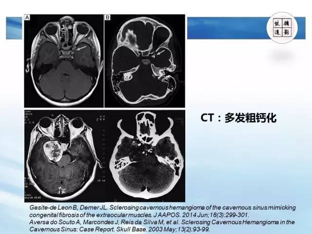 【病例】鞍区海绵状血管瘤1例MR影像表现与鉴别