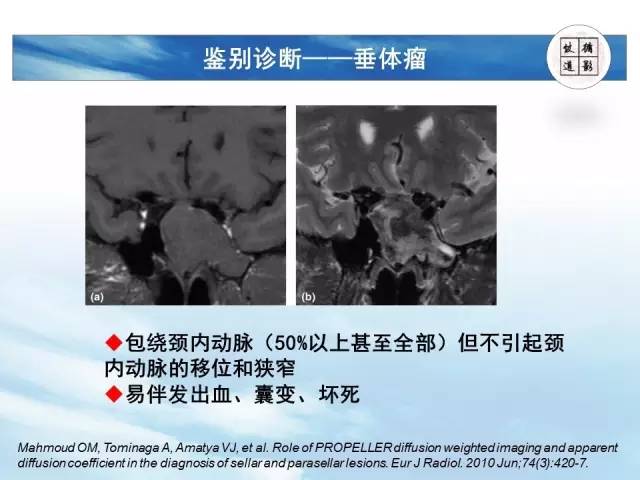 【病例】鞍区海绵状血管瘤1例MR影像表现与鉴别