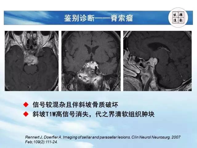 【病例】鞍区海绵状血管瘤1例MR影像表现与鉴别