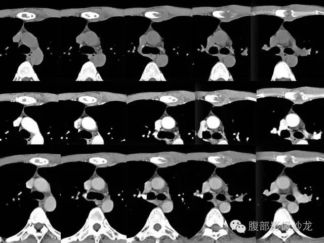 【病例】胸骨结核1例CT影像表现 【病例】胸骨结核1例CT影像表现