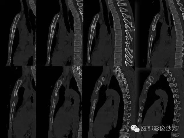 【病例】胸骨结核1例CT影像表现 【病例】胸骨结核1例CT影像表现