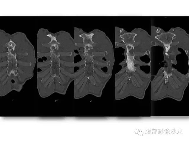 【病例】胸骨结核1例CT影像表现 【病例】胸骨结核1例CT影像表现