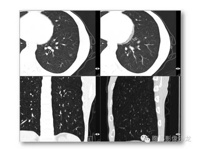 【病例】胸骨结核1例CT影像表现 【病例】胸骨结核1例CT影像表现