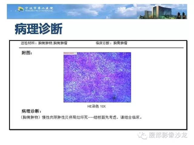 【病例】胸骨结核1例CT影像表现 【病例】胸骨结核1例CT影像表现
