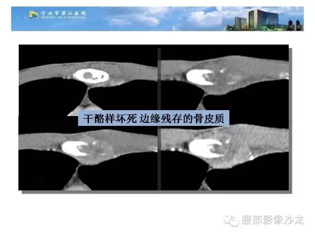 【病例】胸骨结核1例CT影像表现 【病例】胸骨结核1例CT影像表现