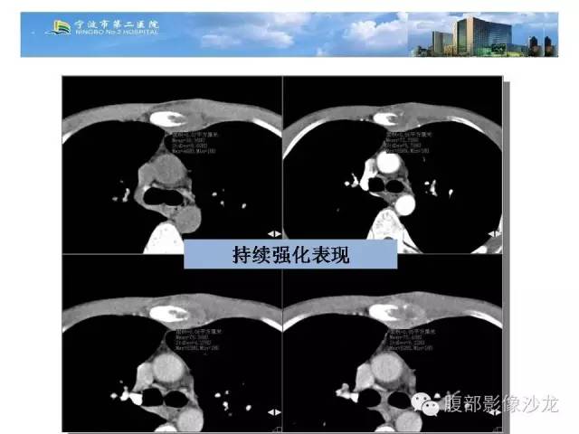【病例】胸骨结核1例CT影像表现 【病例】胸骨结核1例CT影像表现