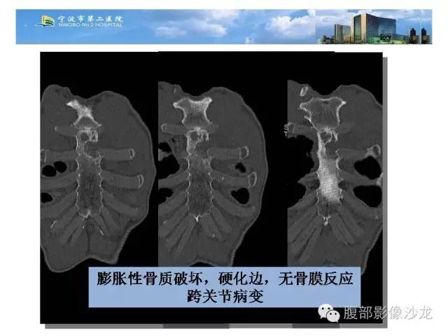 【病例】胸骨结核1例CT影像表现 【病例】胸骨结核1例CT影像表现