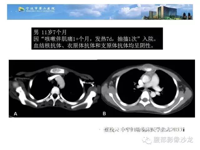 【病例】胸骨结核1例CT影像表现 【病例】胸骨结核1例CT影像表现