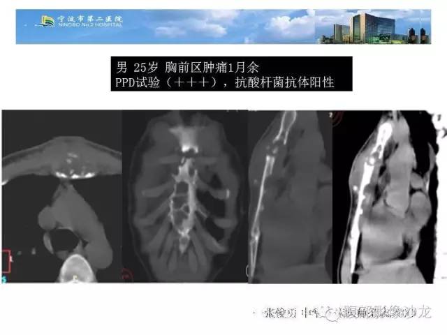【病例】胸骨结核1例CT影像表现 【病例】胸骨结核1例CT影像表现