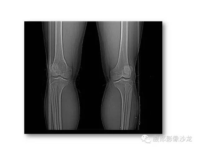 【病例】股骨纤维组织细胞瘤1例影像表现