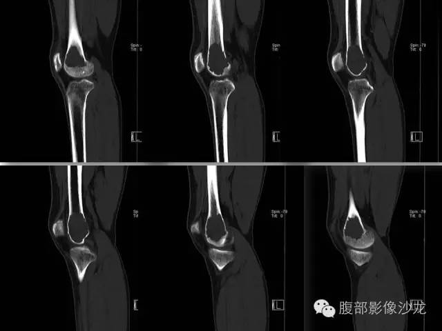 【病例】股骨纤维组织细胞瘤1例影像表现