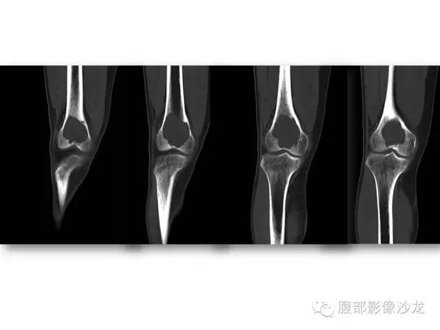 【病例】股骨纤维组织细胞瘤1例影像表现
