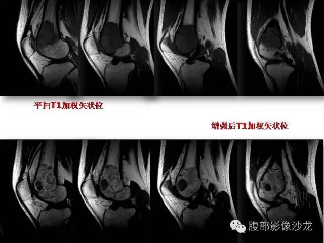 【病例】股骨纤维组织细胞瘤1例影像表现