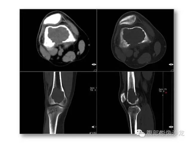 【病例】股骨纤维组织细胞瘤1例影像表现