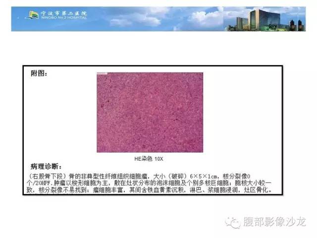 【病例】股骨纤维组织细胞瘤1例影像表现
