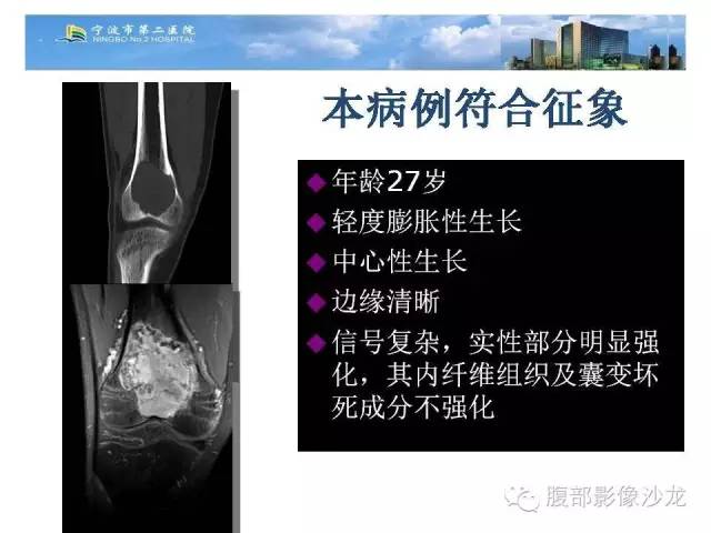 【病例】股骨纤维组织细胞瘤1例影像表现