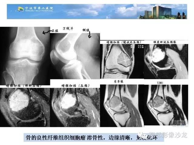 【病例】股骨纤维组织细胞瘤1例影像表现