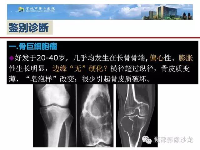 【病例】股骨纤维组织细胞瘤1例影像表现