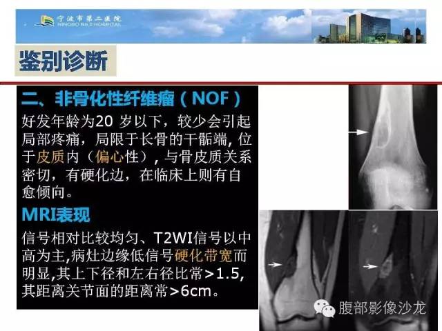 【病例】股骨纤维组织细胞瘤1例影像表现