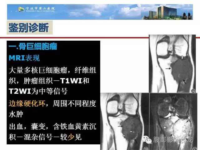 【病例】股骨纤维组织细胞瘤1例影像表现