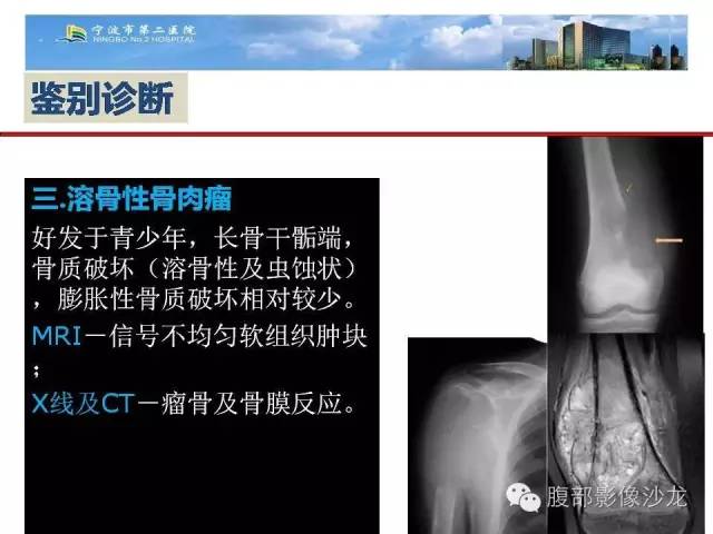 【病例】股骨纤维组织细胞瘤1例影像表现