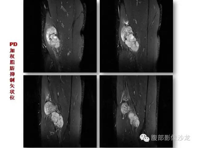 【病例】左大腿孤立性纤维瘤1例MR影像表现