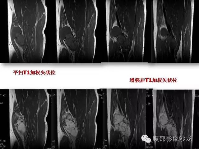 【病例】左大腿孤立性纤维瘤1例MR影像表现