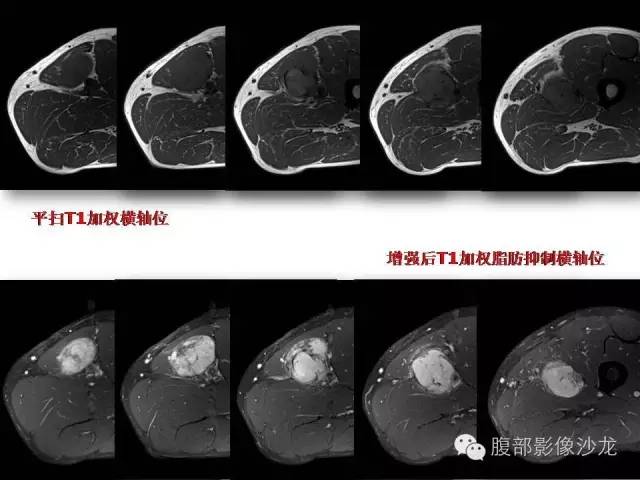 【病例】左大腿孤立性纤维瘤1例MR影像表现