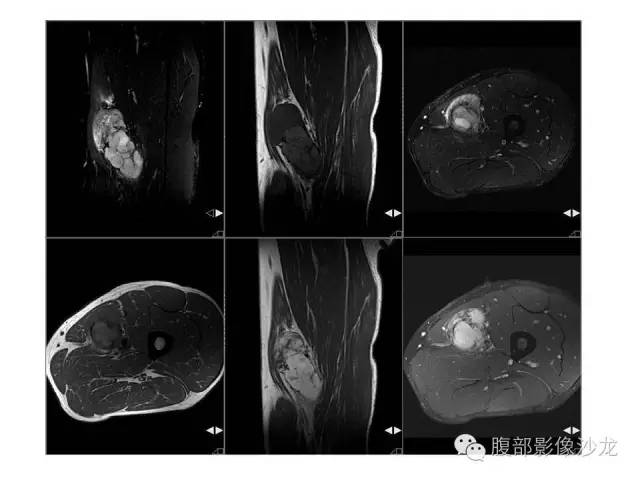 【病例】左大腿孤立性纤维瘤1例MR影像表现