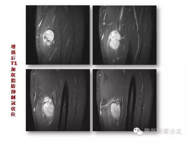 【病例】左大腿孤立性纤维瘤1例MR影像表现