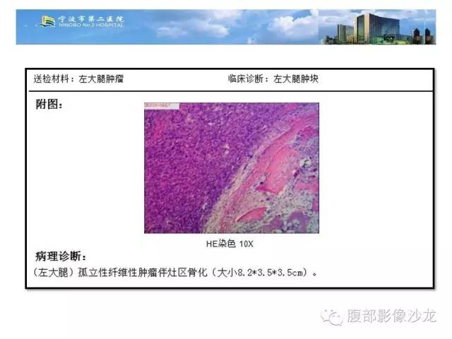 【病例】左大腿孤立性纤维瘤1例MR影像表现