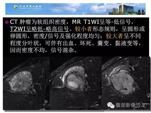 【病例】左大腿孤立性纤维瘤1例MR影像表现