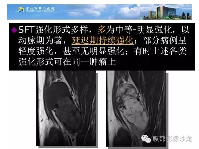 【病例】左大腿孤立性纤维瘤1例MR影像表现