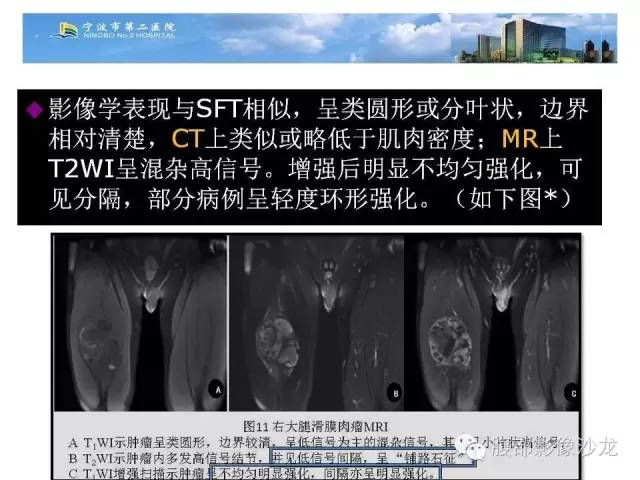 【病例】左大腿孤立性纤维瘤1例MR影像表现