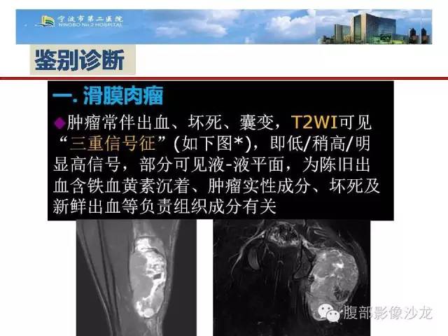 【病例】左大腿孤立性纤维瘤1例MR影像表现