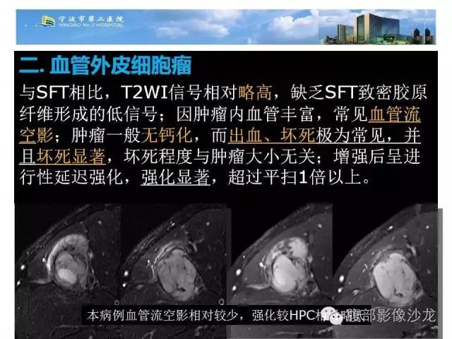 【病例】左大腿孤立性纤维瘤1例MR影像表现