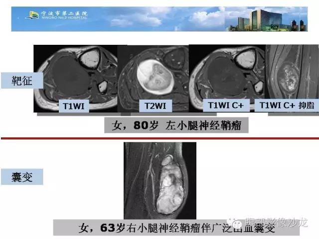 【病例】左大腿孤立性纤维瘤1例MR影像表现