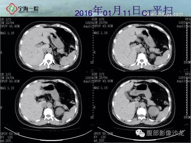 【病例】左肾滑膜肉瘤1例CT影像表现