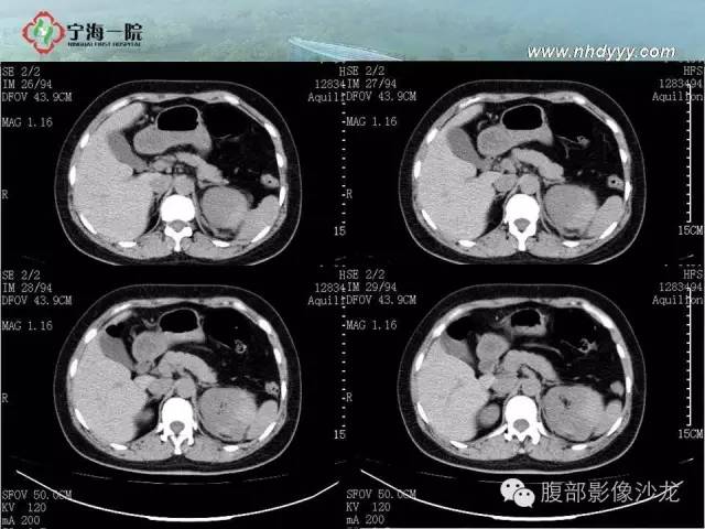 【病例】左肾滑膜肉瘤1例CT影像表现