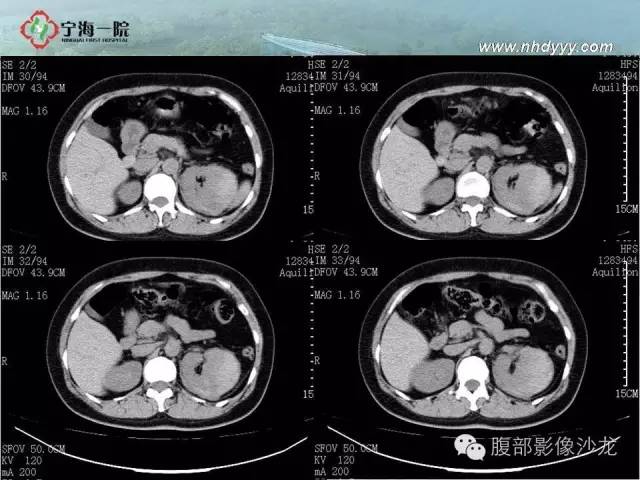 【病例】左肾滑膜肉瘤1例CT影像表现