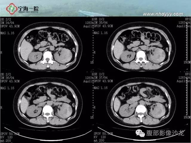 【病例】左肾滑膜肉瘤1例CT影像表现