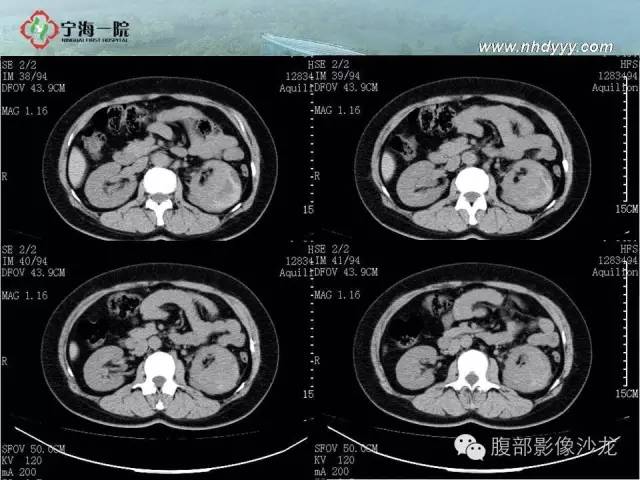 【病例】左肾滑膜肉瘤1例CT影像表现