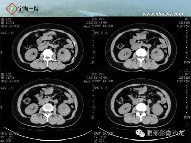 【病例】左肾滑膜肉瘤1例CT影像表现