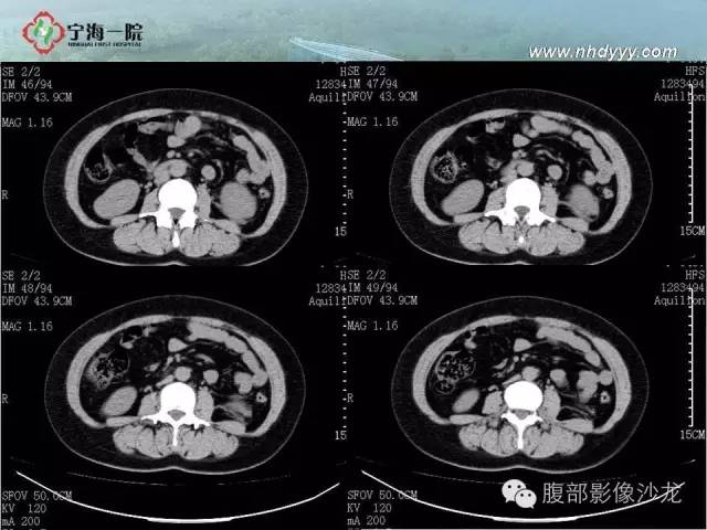 【病例】左肾滑膜肉瘤1例CT影像表现