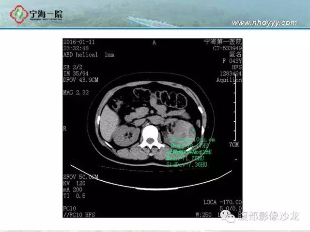 【病例】左肾滑膜肉瘤1例CT影像表现