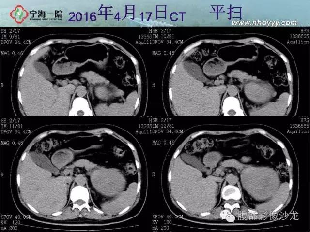 【病例】左肾滑膜肉瘤1例CT影像表现
