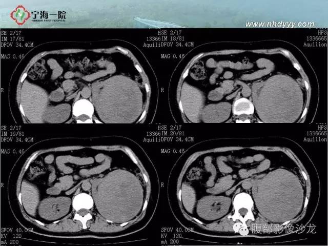 【病例】左肾滑膜肉瘤1例CT影像表现